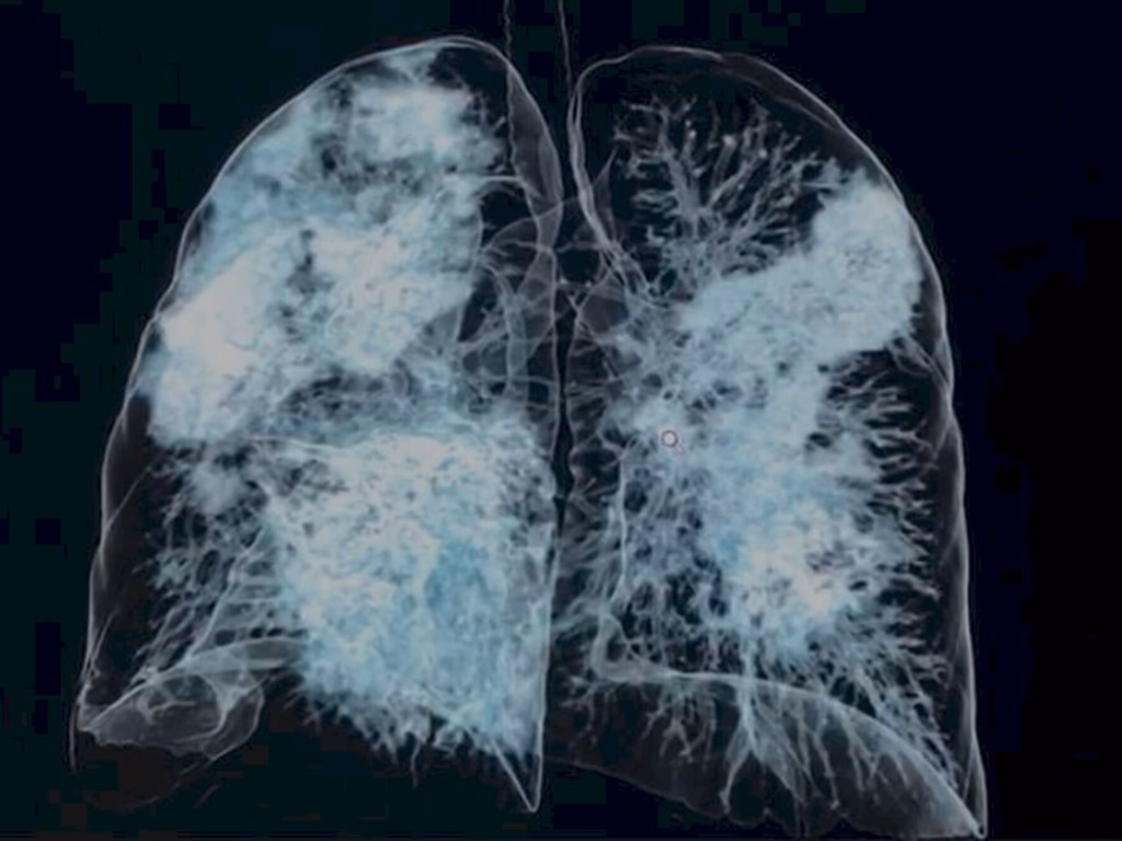 Seminário virtual aborda importância da Radiologia na Covid-1