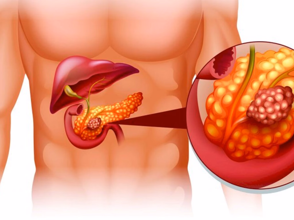 Câncer de pâncreas e fígado estão em estimativa para os próximos anos