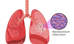 Anvisa aprova medicamento que reduz risco de morte em até 89%