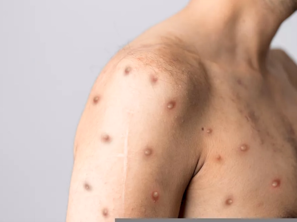 Segundo caso de Monkeypox é confirmado em Uruguaiana