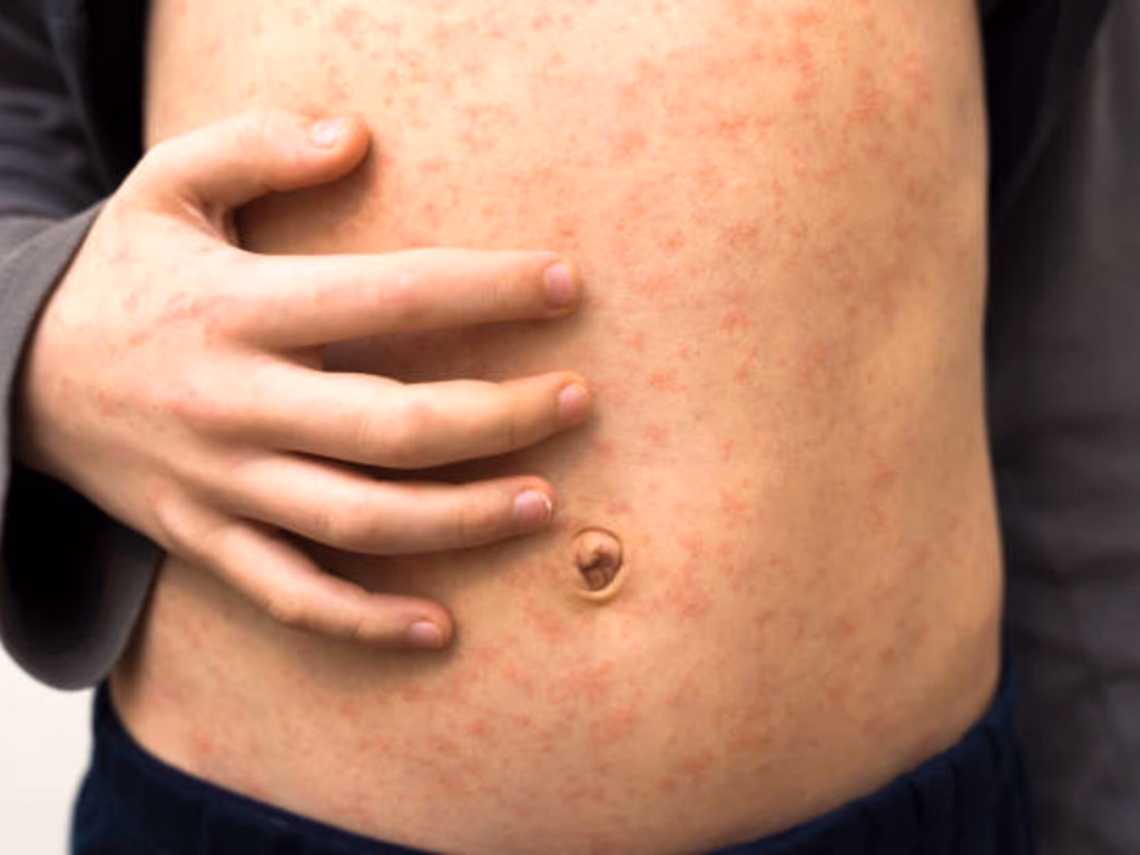 Município intensifica campanha de vacinação contra o sarampo