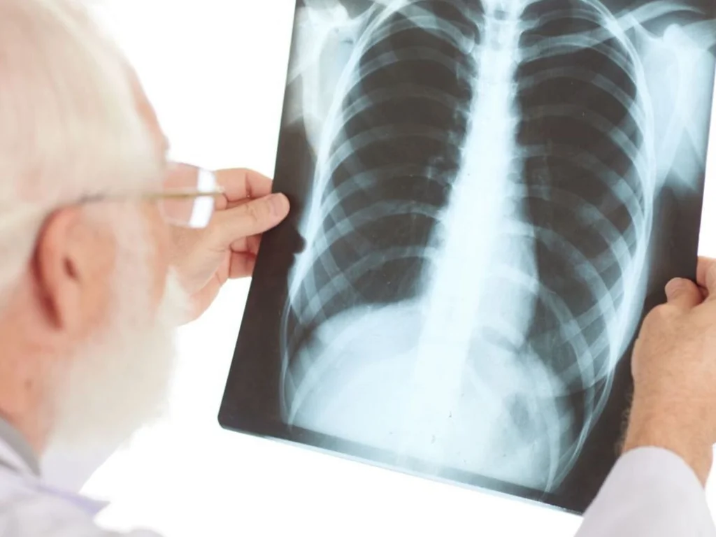 Estado monitora casos de tuberculose em pessoas em situação de rua