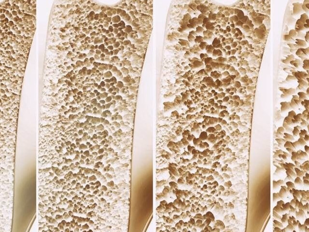 Osteoporose atinge dez milhões de pessoas no Brasil
