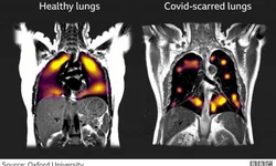 Exame pioneiro mostra danos em pulmões três meses após a infecção