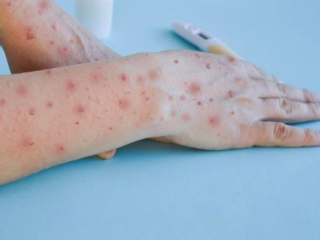 Estado confirma cinco casos, mas nenhum é da nova cepa