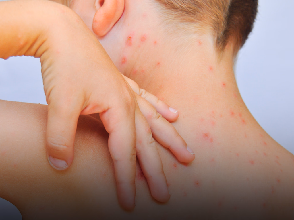 Cobertura vacinal contra sarampo está baixa em Uruguaiana