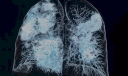 Seminário virtual aborda importância da Radiologia na Covid-1