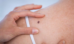 Aluna da Unipampa desenvolve IA para apoiar diagnóstico de câncer de pele