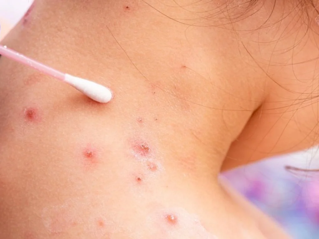 Saiba quais são os sintomas e protocolos diante de suspeita