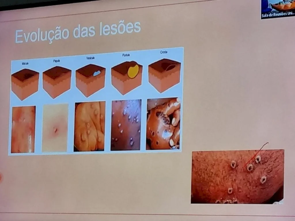 Saúde explica critérios para definição de suspeitos