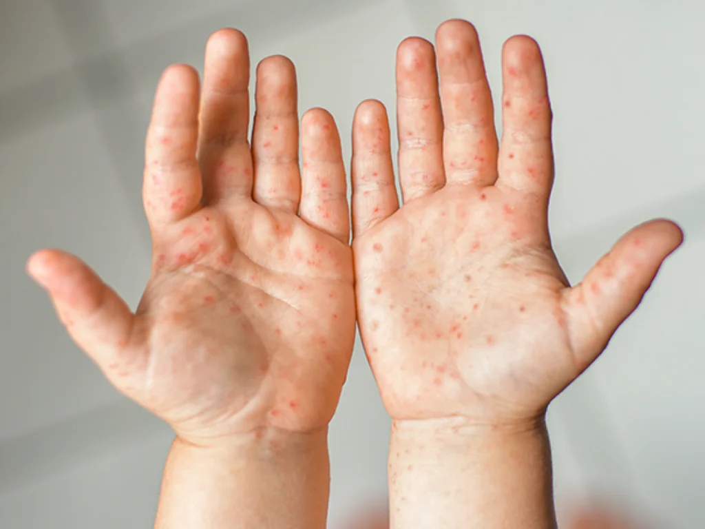 Vigilância do Estado alerta para casos de mão-pé-boca