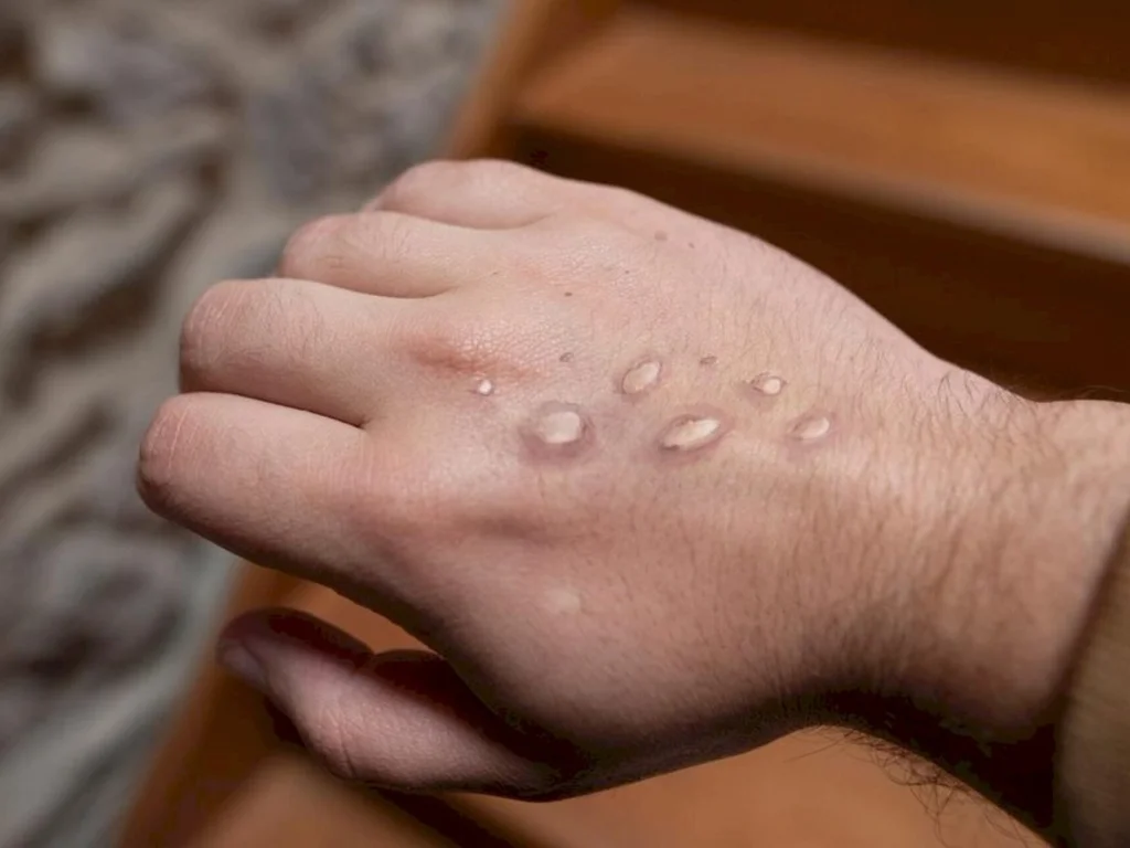 Dom Pedrito tem um caso suspeito de varíola dos macacos