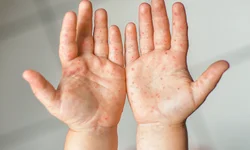 Bagé confirma primeiro caso de dengue do ano