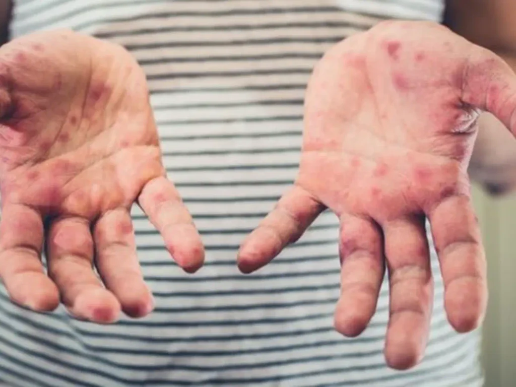 Confirmação de caso de sarampo acende alerta