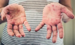 Bagé registra cinco casos confirmados de dengue