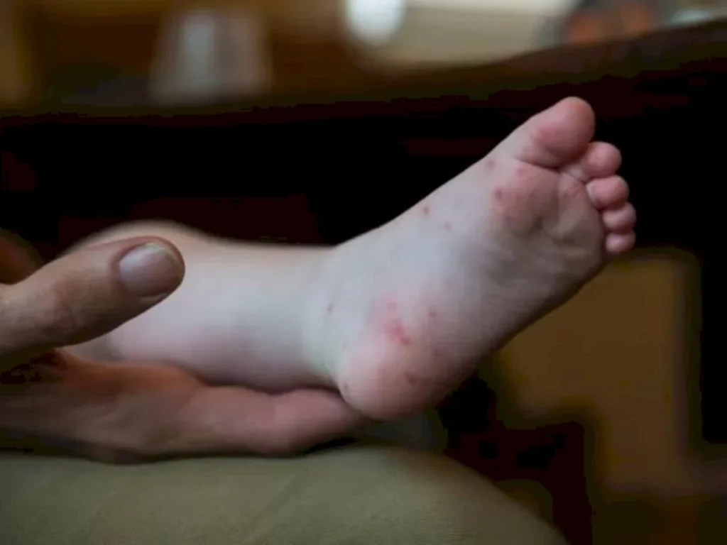 Casos da doença mão-pé-boca colocam pais em alerta