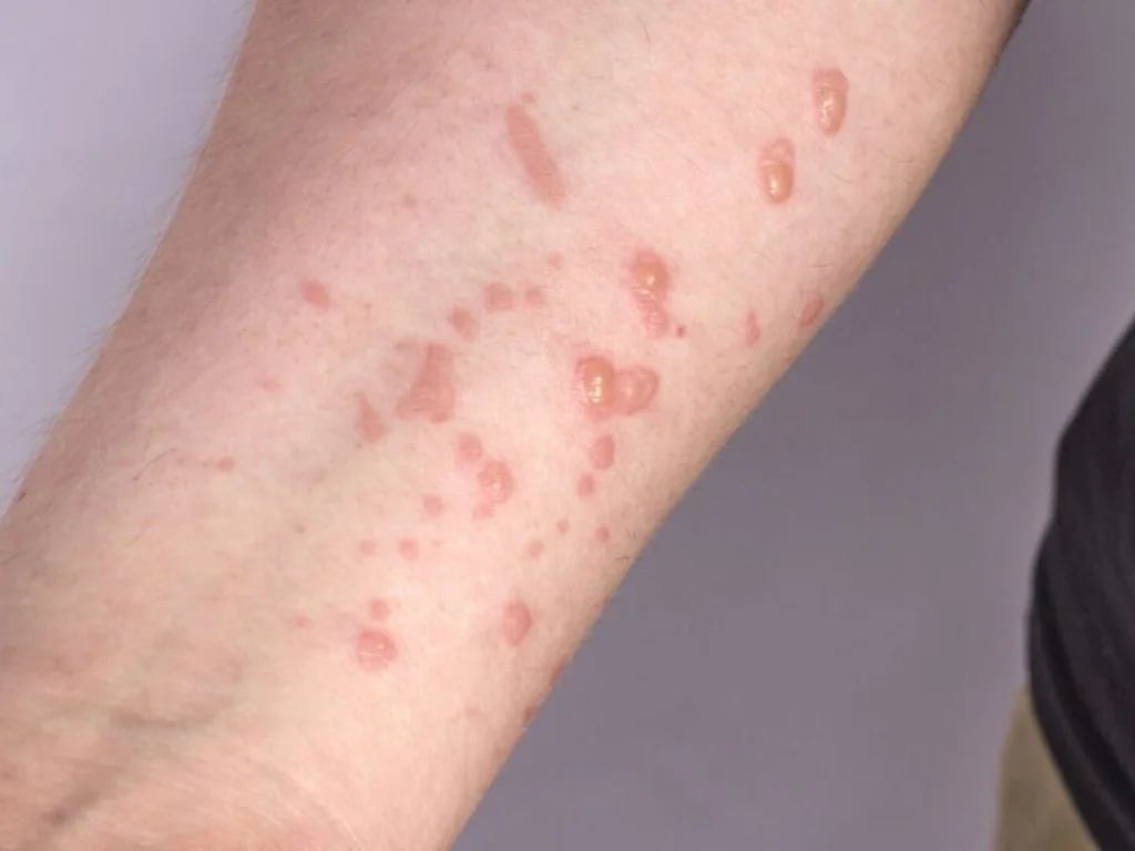 Estado reage a suba de casos de varíola